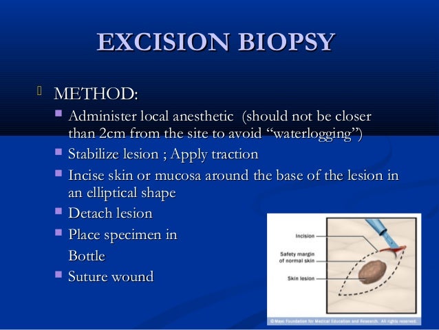 excisional breast biobsy Excisional breast biobsy